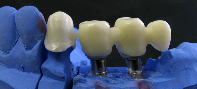 cappe in zirconia